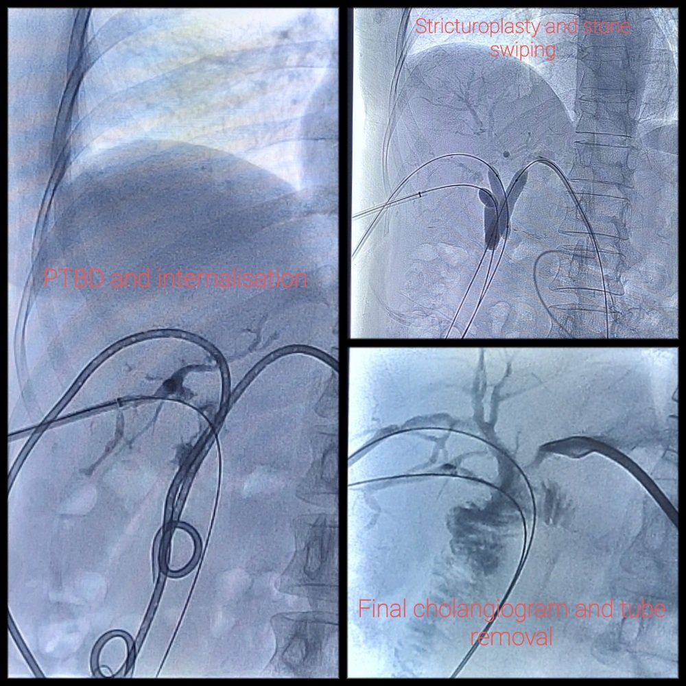 One year journey through HJ stricture, 3 system PTBD, Internalisation, Stricturoplasties, stone clearance, tube changes to tube removal. Patients need a lot of patience throughout the journey.  Grateful to all referring seniors, colleagues and patients
#biliaryinterventions