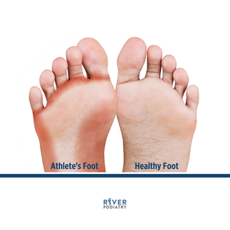 River_Podiatry's tweet photo. Athlete’s Foot is a fungal skin infection that is contagious and affects the skin on the soles of your feet and in between your toes. Click the link below to learn more. 

https://t.co/LPF7iEgCFD https://t.co/PaX4Sx8luM