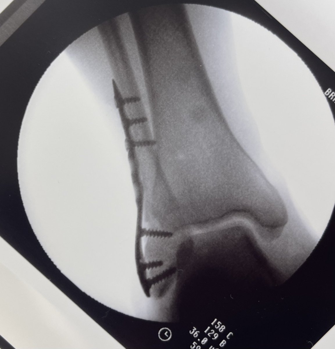 First Distal Fib case - add it to the list of sterile packed solutions!  #orthotwitter
