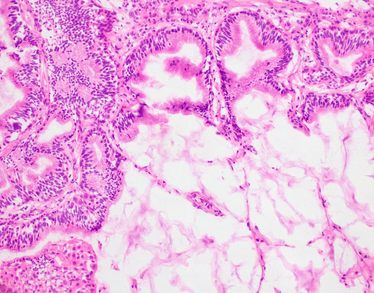 Frozen section for a 6 mm lung nodule. What is the diagnosis? #BWHPathCOTW #Pulmpath 1/4