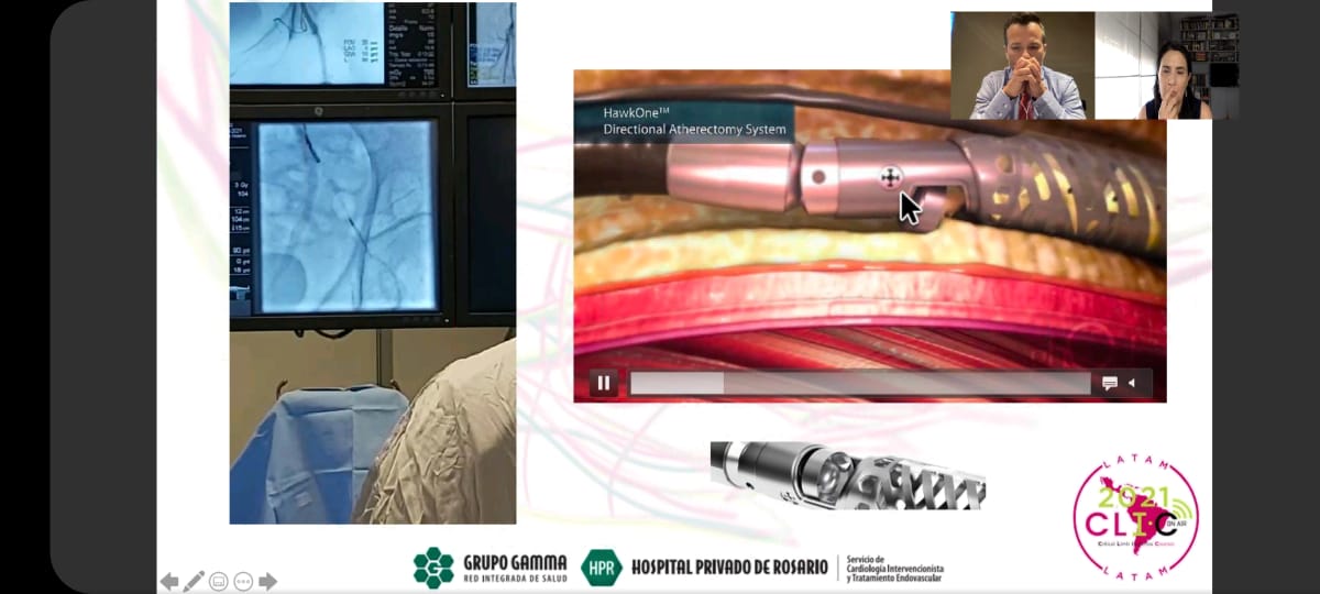 SCITE_HPR's tweet photo. Compartimos participación de @claudiocigalini en la última sesión @CliLatam 2021:
Aterectomía direccional #HawkOne | Datos clínicos y rol en la preparación del vaso
#CliFighters #CardioEd #CardioTwitter https://t.co/nO146gILSU