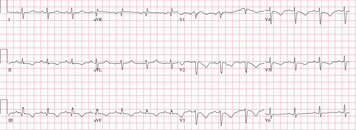 EM_RESUS's tweet image. Here’s an #ECG of 45 year old man with chest pain and shortness of breath. There’s a very important pattern here pointing to a critical diagnosis.

What is it?