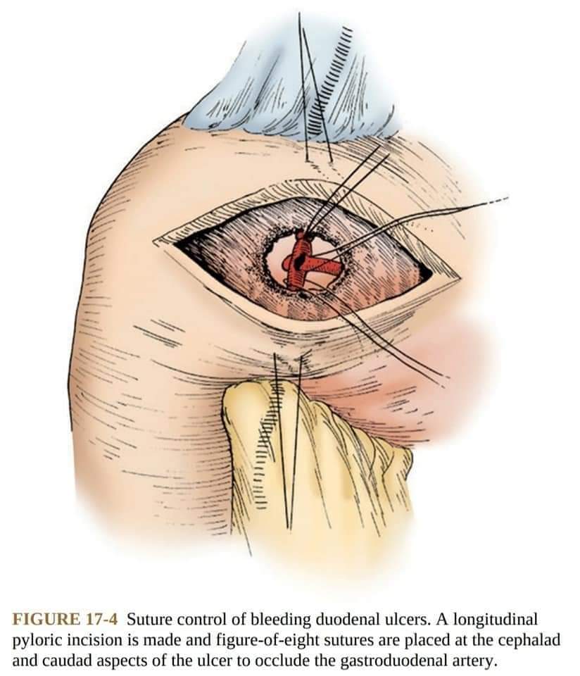 DRAFTABAHMED7's tweet photo. •Technique of suture control of a bleeding duodenal ulcer.
#peritonitis
#Generalsurgery
@EuropeanCancer
#MISIRGlobalSurgery
#SoMe4HPB
#SoMe4IQLatAm #SoMe4Surgery #Medtwitter
#4KMedEd #LiverTwitter
#MedicalEducation
#USMLE
#duodenalulcer
#pepticulcer
#bleedingulcer https://t.co/GmkVUf2pZG
