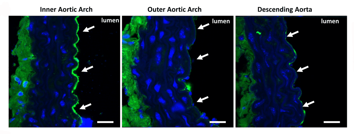 CircRes's tweet photo. Baseshore &amp; colleagues show that cells in arterial branches and curves metabolize more #glucose which decreases how much protective #NO they make. Reducing glucose upta... #HeartAttack #stroke. https://t.co/Ldi4kjc4ve
@Sare_Bear24 @Clyne_Lab @callie_weber_ @swathi1287 @YujiZhang1 https://t.co/K1nPkkx5Fa