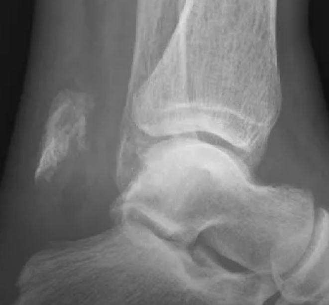 Fracture or ossification? Answer = ow.ly/5vrN50GYUxx