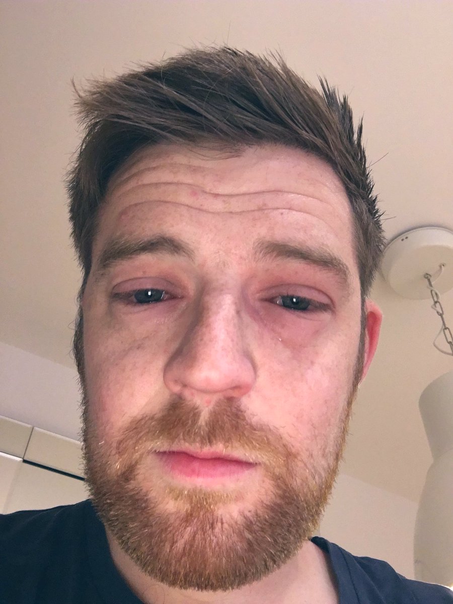 StomaCop's tweet photo. Crohn’s and Colitis can cause other secondary conditions. This photo was November 2017 during a flare up. Eyes inflammed so much eventually I couldn’t see out of one of them. @CrohnsColitisUK #CrohnsAndColitisAwarenessWeek https://t.co/k7dB9kjg3H