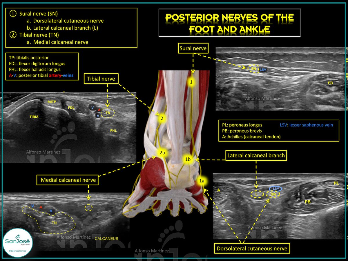 POSTERIOR NERVES OF THE FOOT AND ANKLE.- 
Evaluation of the posterior nerves of the foot and ankle by ultrasound.
Training with the book ECO MSK FOOT AND ANKLE by   Fernando Jimenez Díaz and Marbán Libros <a href="/fjdconesa/">Dr. Fernando Jimenez</a> <a href="/Marban_Libros/">Marbán Libros</a>  
#ultrasound 
#footandankle
#SanJoseClinic