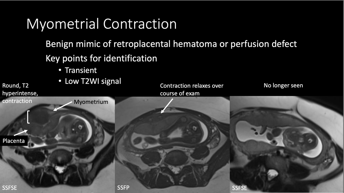 MorganMcLuckey's tweet photo. What is the significance of a subchorionic versus intraplacental hematoma? How to identify placental ischemia? Benign mimics of placental hematoma? Come visit our #pedsrad educational exhibit to find out! @_LindseyWells @marianazmeyers @brandonbrownmd #RSNA2021 https://t.co/UA76Zc7yyu