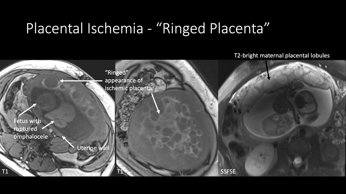 What is the significance of a subchorionic versus intraplacental hematoma? How to identify placental ischemia? Benign mimics of placental hematoma? Come visit our #pedsrad educational exhibit to find out! <a href="/_LindseyWells/">Lindsey (Wells) Wood</a> <a href="/marianazmeyers/">Mariana Meyers</a> <a href="/brandonbrownmd/">Brandon Brown</a> #RSNA2021