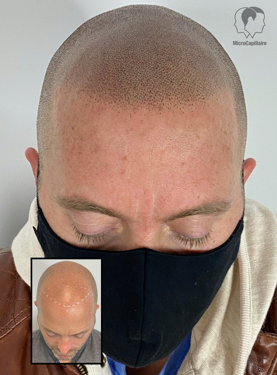 microcapillaire's tweet photo. Best solution to hair loss #scalpmicropigmentation #scalpmicropigmentation #smp 

https://t.co/aQbqDbTvsX https://t.co/s4hTwsYZb6