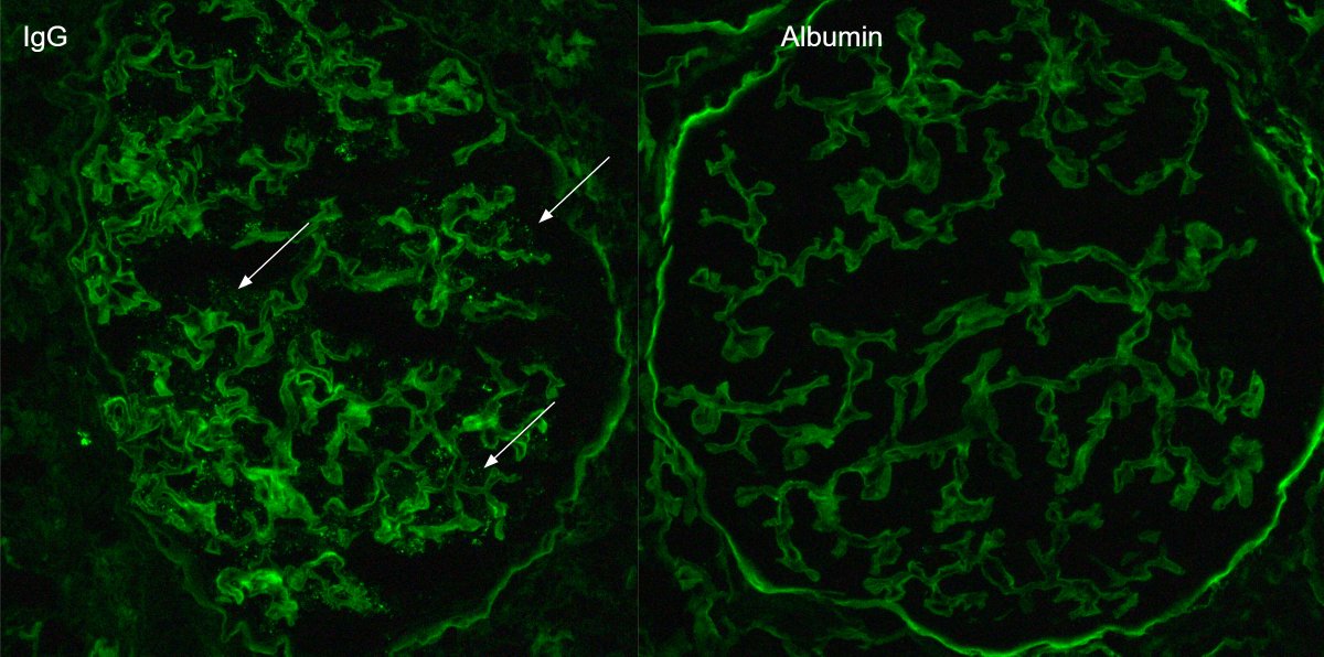 JZRenalPath's tweet photo. Another example of podocyte dusting with IgG in a case of diffuse podocytopathy (MCD) relapse ~1 week after COVID19 booster. Also some low grade IgA deposition. Diffuse podocyte FPE. #renalpath #nephropath https://t.co/qA1DhJsADQ