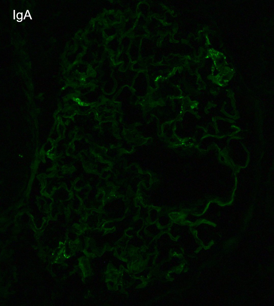 JZRenalPath's tweet photo. Another example of podocyte dusting with IgG in a case of diffuse podocytopathy (MCD) relapse ~1 week after COVID19 booster. Also some low grade IgA deposition. Diffuse podocyte FPE. #renalpath #nephropath https://t.co/qA1DhJsADQ