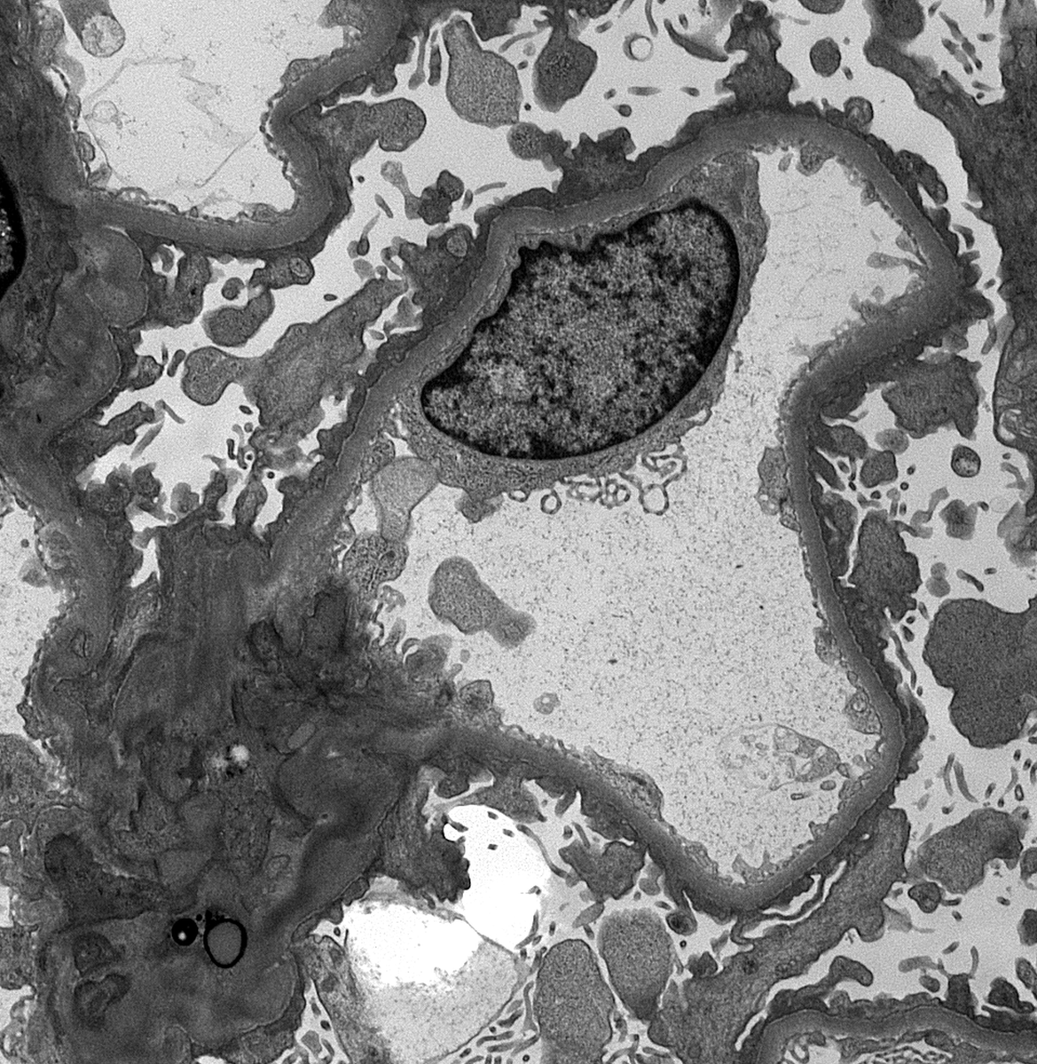 JZRenalPath's tweet photo. Another example of podocyte dusting with IgG in a case of diffuse podocytopathy (MCD) relapse ~1 week after COVID19 booster. Also some low grade IgA deposition. Diffuse podocyte FPE. #renalpath #nephropath https://t.co/qA1DhJsADQ