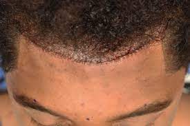 Forehead hair transplant in germany. руни пересадка волос. Forehead hair transplant in germany. Forehead hair transplant in germany. Man hair transplant before after.