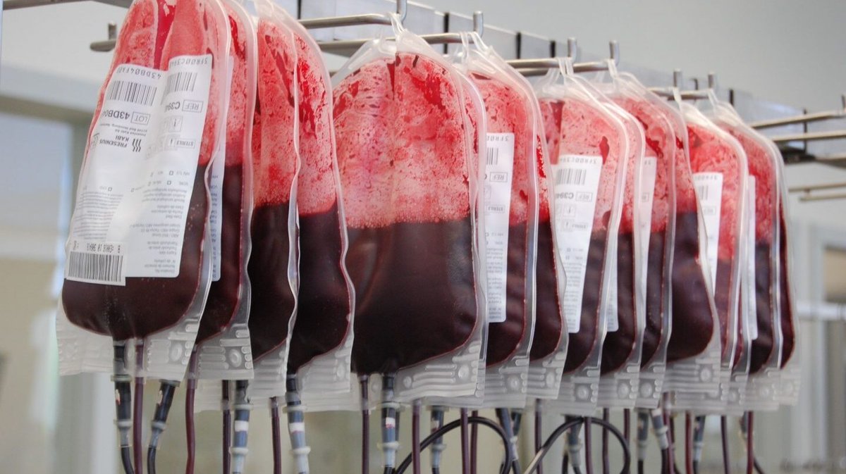 sedar_es's tweet photo. #SHTFSEDAR La #transfusión sanguínea 👉🏻  daño #renal. Almacenamiento #Hematies 👉🏻 ⬆️ citoquinas.👀 Pero NO hay diferencia en la incidencia de daño renal postransfusión entre CH frescos y de almacenamiento prolongado #AKI #INFORM_trial ¡Comparte! 🗣️🔗 https://t.co/q9zmIqZ7xK https://t.co/mAO9wXin22
