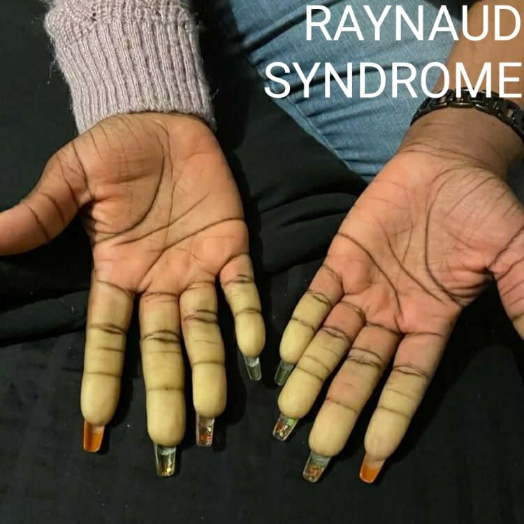 Raynaud syndrome causes arteries in the fingers (or toes, nose) to temporarily narrow. This results in reduced blood flow and a dramatic lightening of the area. It can be uncomfortable. Common triggers are cold and stress. #MedTwitter #dermtwitter #BLM