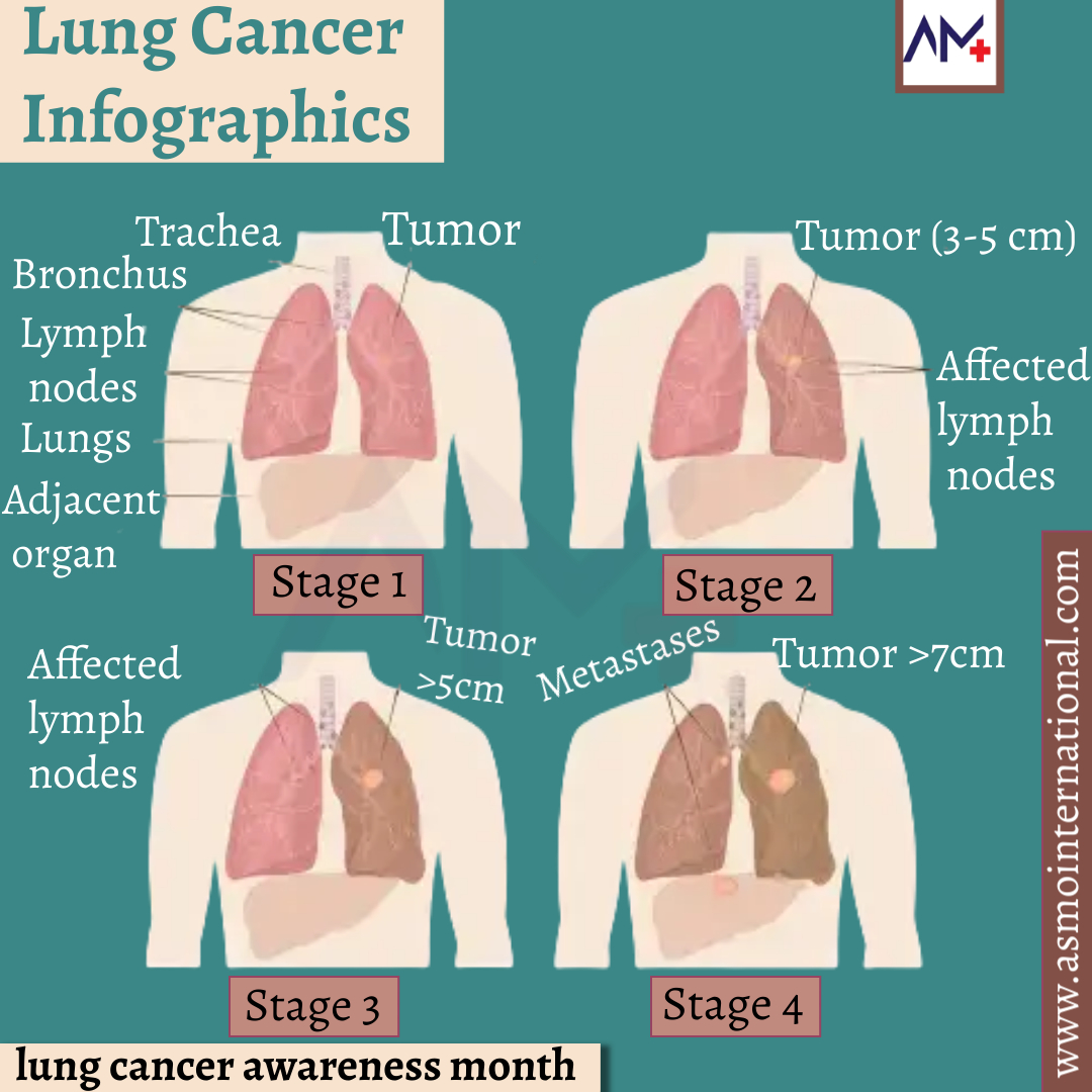 ashimamunjal05's tweet photo. Lung Cancer Stages
.
https://t.co/9yLJI3KuIt
.
#lungs #lungcancer #lungcancerawareness #lungcancerawarenessmonth2021 #lcam2021 #lungcancermonth #lungcancerwarrior #lungcancersurvivor #stopsmoking #infographics #tuesdayvibe #tuesdaythoughts #tuesdayfeeling #tuesdaymotivations https://t.co/o9bNfswUIT
