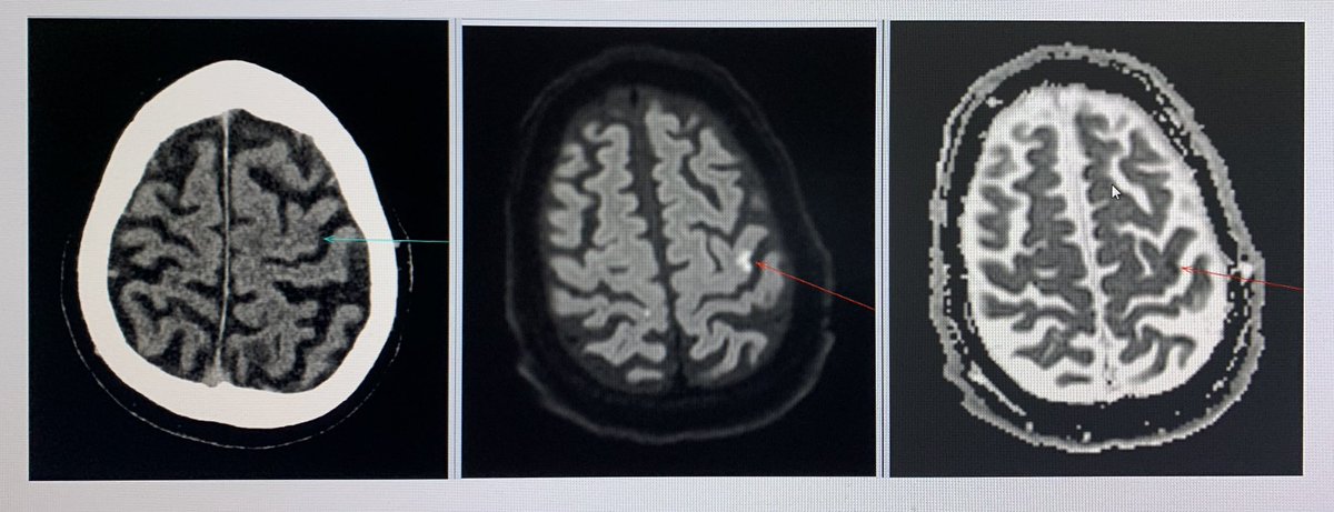 geraldinetranMD's tweet photo. Asking for more info revealed that our patient had right hand weakness and difficulty brushing their teeth. Helped find a small infarct in left pre-central gyrus that would otherwise look similar to background of white matter hypodensities on CT! #radiology #neuroradiology https://t.co/9fmJLhzIPj