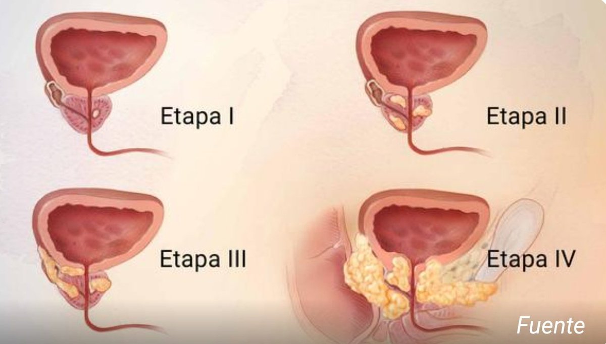 Alimentos q inflaman la prostata