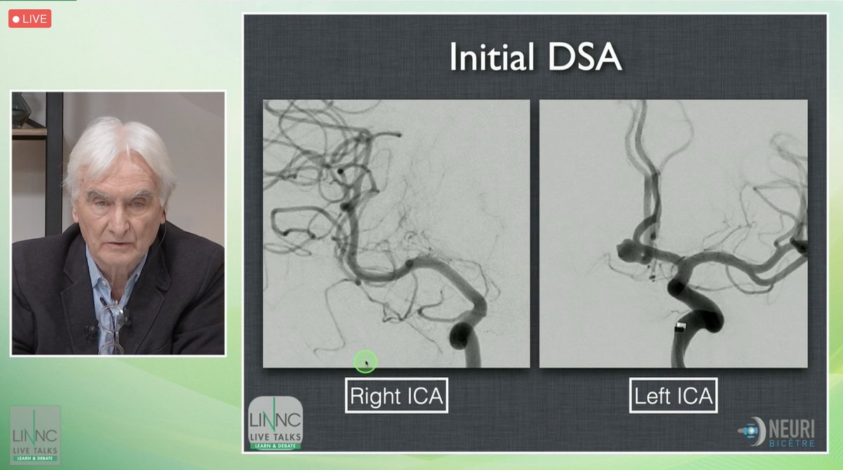 LINNConline's tweet photo. Next recorded #case ๐ A complex aneurysm of the anterior communicating #artery: is Y-stenting with a laser cut-stent the solution? Is using this stent a guarantee of the absence of complications?
#LINNCLT https://t.co/O5mEvVzlJe