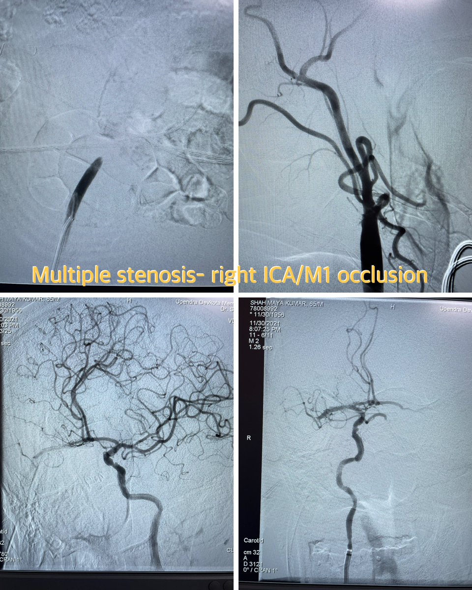 dr_phuyal's tweet photo. Penumbra RED 72…!

Neurointervention- Nepal:
65/M with multiple stenosis with right tandem lesions (ICA bulb stenosis/ MCA occlusion. LKN-1h.
Puncture to recanalization-23mins with single pass. @PenNeuro 

#interventionalradiologynepal #strokeawareness #penumbra https://t.co/sdnt57bTHz