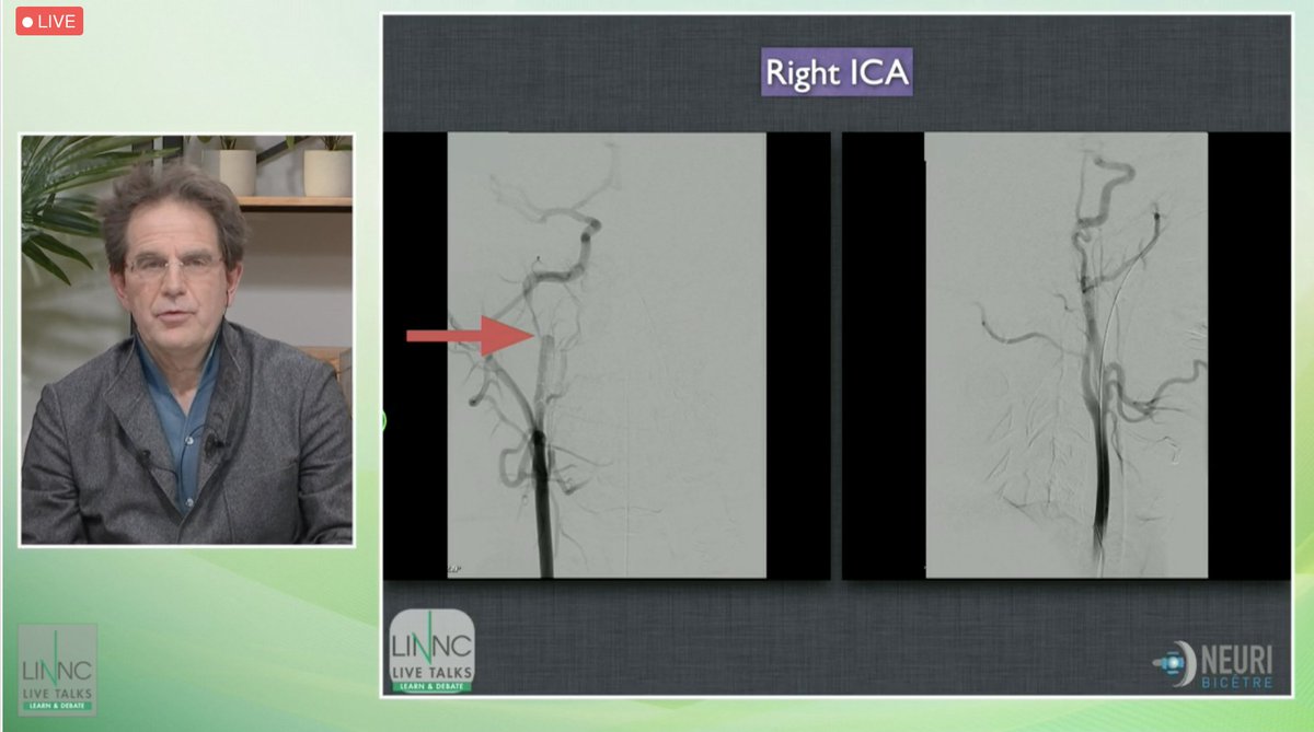 LINNConline's tweet photo. #case: New modalities for the #treatment of a post-traumatic carotid-cavernous #fistula.
#LINNCLT https://t.co/UeUCdA8WtY