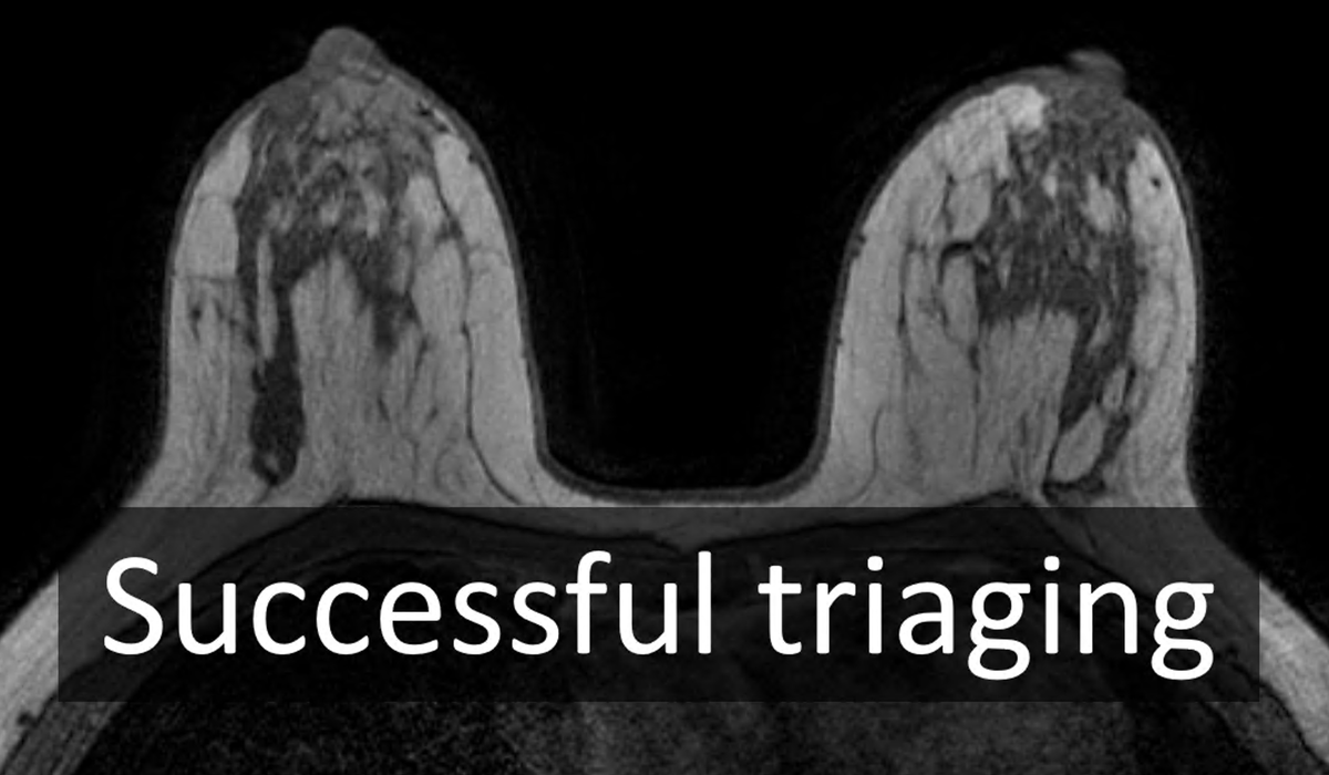 BasvanderVelden's tweet photo. Sneak peak of my talk tomorrow at #RSNA2021: #Triaging women from MRI to #mammography   to adapt #screening to changes in breast   density using #AI

See you there 3PM S406B! https://t.co/w647ZE0ODa