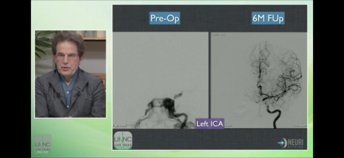 neurofox's tweet photo. A traumatic CC fรญstula treated with stent FD + EVOH. Great result and patency of the artery.
.
.
@LINNConline #LINNCLT
@mirivicente @VitorMendesPer1 @DanielVelaMD @jildazz @VladoKZg @Sremollo @CristianMihalea @PascalJabbourMD @Hopital_Bicetre https://t.co/YFlVpqo6JF