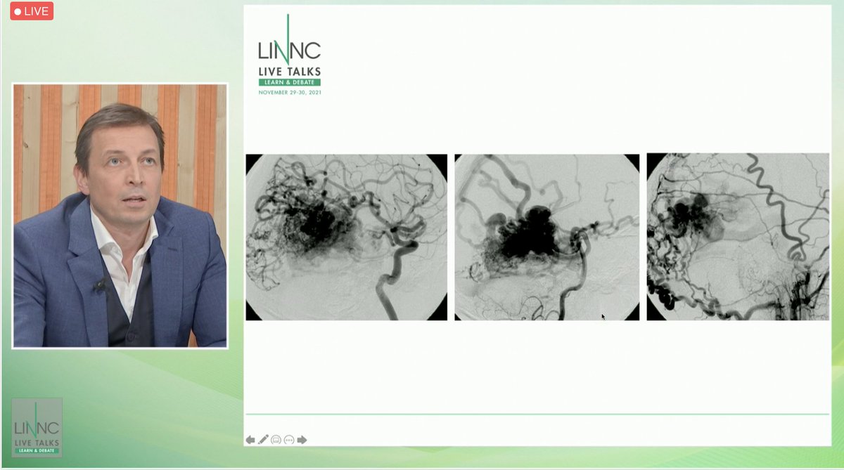 LINNConline's tweet photo. Last #case presented by Zsolt Kulcsar from @Unispital_USZ: Peculiar evolution of an #AVM.
To treat or not to treatโ
#LINNCLT https://t.co/vrzUk61lu0