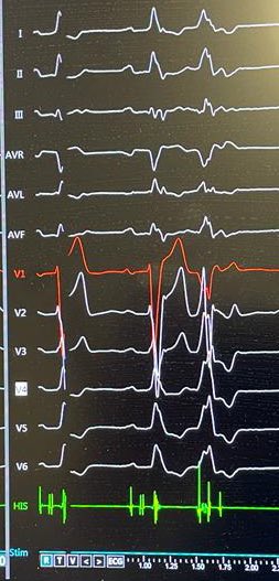 Today a good old fashioned HBP CRT-d case, in a proctor session with <a href="/LUMC_Leiden/">LUMC Leiden</a>. Very illustrative with al sorts of output dependant QRS morphologies, NSHBP with corr LBTB, SHBP with and without corr LBTB, retrograde LB invasion, and this👇#dontdisthehis #epeeps