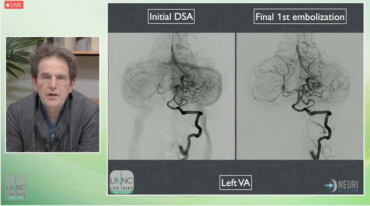 LINNConline's tweet photo. Last #case from #LINNCLT first edition: A cerebellar #AVM in a sickle cell #patient, with the decision taken to favor the venous approach. Were all precautions taken to avoid complications? โฌ https://t.co/PKXNhTzxGp