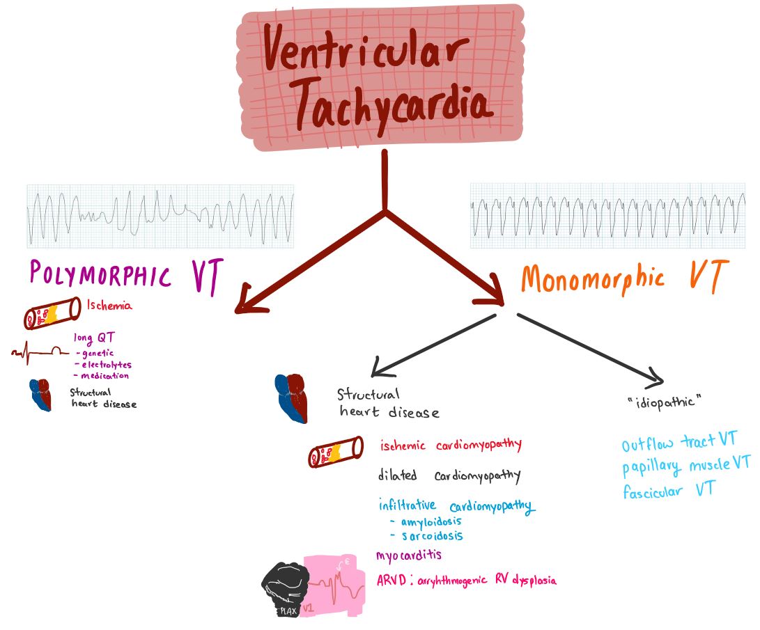 StanfordChiefs's tweet photo. 3) Sometimes reading the words "ventricular tachycardia" is enough to put you in VT. Here's one (non-exhaustive) approach to thinking about causes. [3/3] https://t.co/huUghJEQsX