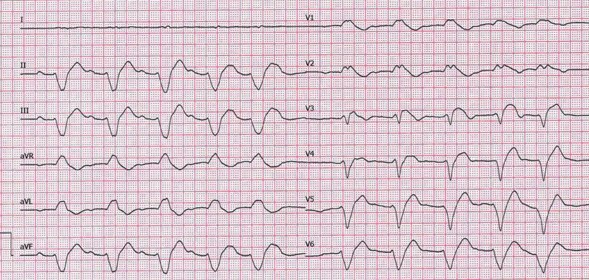 malagu_m's tweet photo. @Feff93 @FiorioAlessio #EPeeps #ECG #quiz #Poll https://t.co/VmJ70rjgep