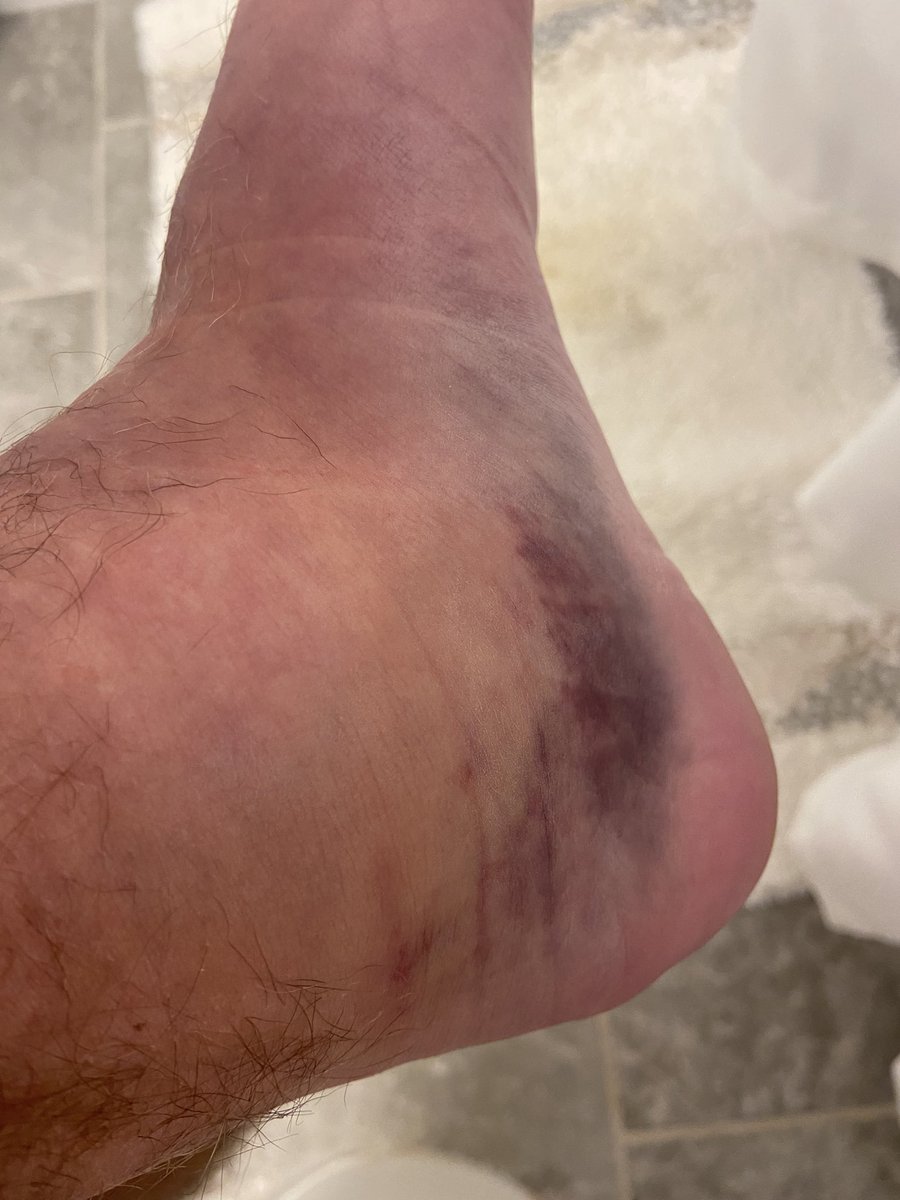 RyanRagnarokPro's tweet photo. Hey guys, for those who saw today’s episode of GTS, it featured the match I was injured. Here is the aftermath. I am seeing the doctor on Monday as it’s the earliest appointment I could get minus going to the hospital. Nothing but love for @JoeDice_ accidents happen in the biz https://t.co/rwUY2mGQSH