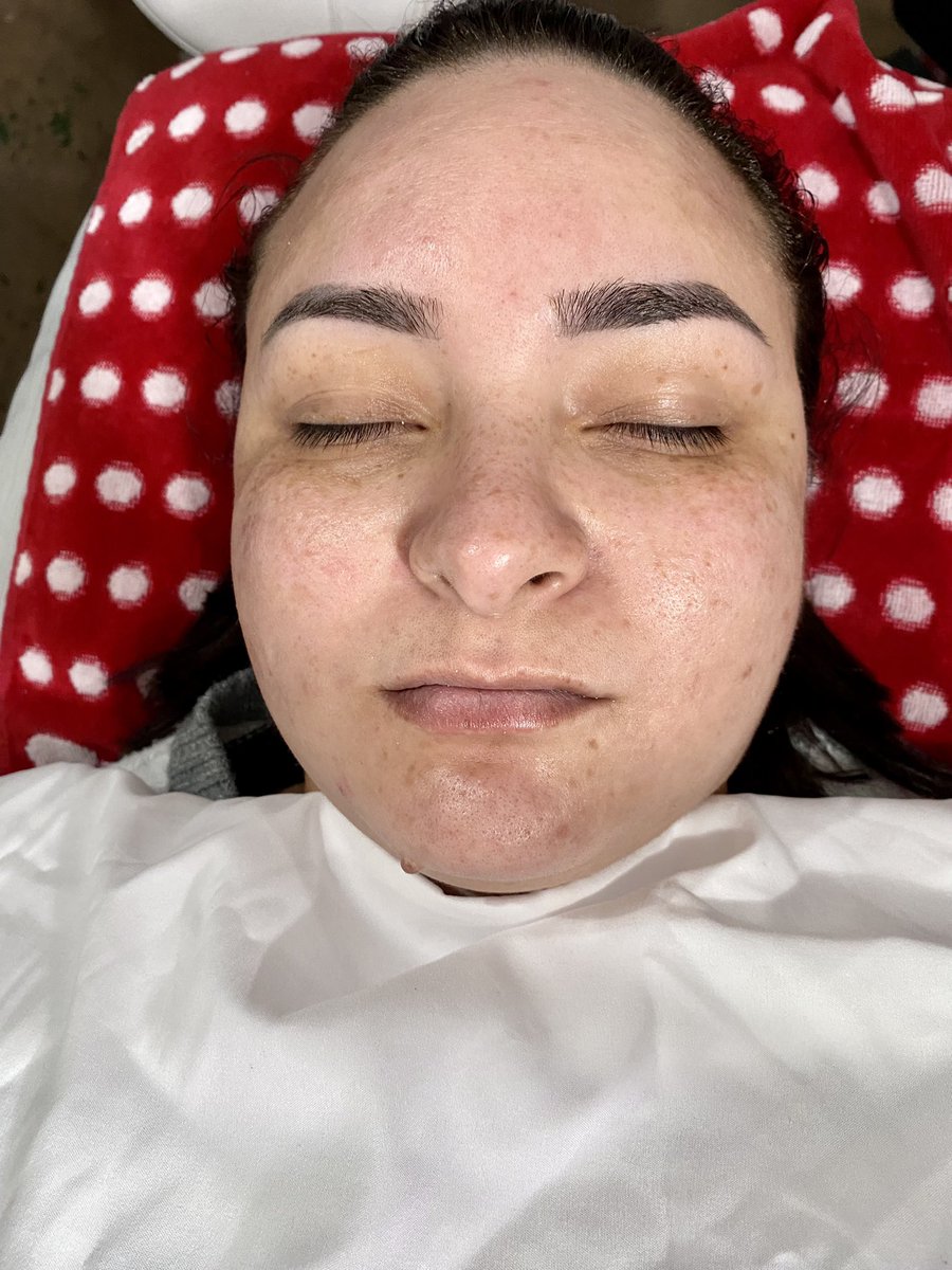 slimtheesty_'s tweet photo. Book your next facial with me, TODAY! Appointments are available 📲

Here’s a quick before and after shot of a “ glow me up, DIOSA “ signature facial 🙉 
New clients must fill out forms as well as book a consultation. Start your skins journey TODAY ! 
https://t.co/norHJhr8V6 https://t.co/19x9pGMc3j