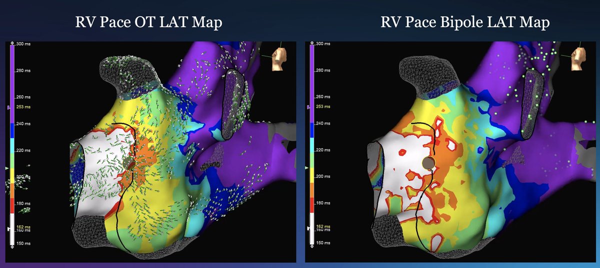 Ryan Oatman (@ryan_otman) on Twitter photo Unedited Omnipolar Technology (OT) LAT Map vs unedited Standard Bipolar LAT map for a left lateral pathway utilizing the open window mapping technique. Who doesn’t love a one burn term? <a href="/aalahmadmd/">Amin Al-Ahmad, MD</a> <a href="/AbbottCardio/">Abbott Cardiovascular</a> #EPeeps #TrueEGMs #OnlyWithOT #EnsiteX Unedited Omnipolar Technology (OT) LAT Map vs unedited Standard Bipolar LAT map for a left lateral pathway utilizing the open window mapping technique. Who doesn’t love a one burn term? <a href="/aalahmadmd/">Amin Al-Ahmad, MD</a> <a href="/AbbottCardio/">Abbott Cardiovascular</a> #EPeeps #TrueEGMs #OnlyWithOT #EnsiteX