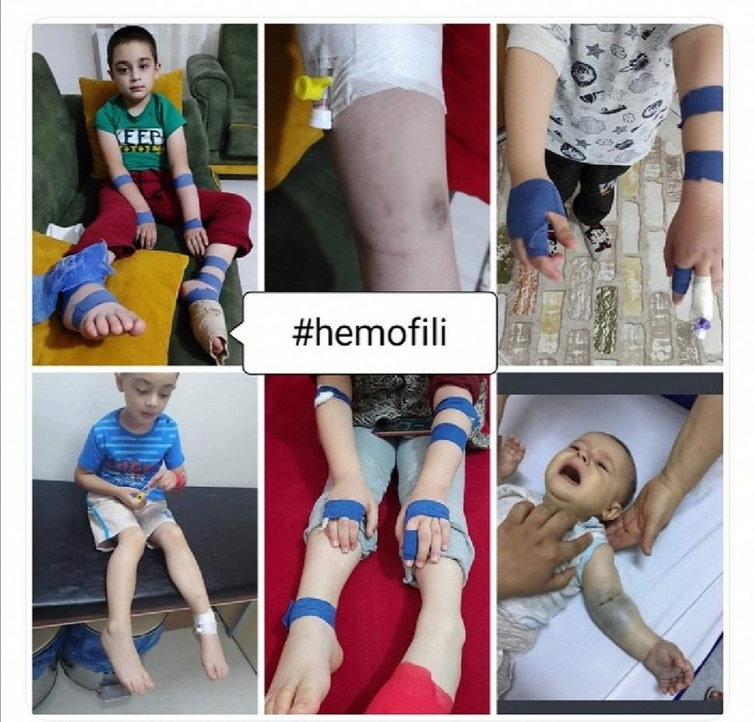 Alpi070707's tweet photo. @Akparti #hemofili çocukları 2.5 yıldır sağlık bakanlığının onayladığı @sgksosyalmedya tarafından geri ödemeye almadığı #derialti #hemlibra ilacını bekliyor. Daha kaç yıl acı çeksin acil köşelerinde ağlasın bu çocuklar. https://t.co/mL7fi6St5K