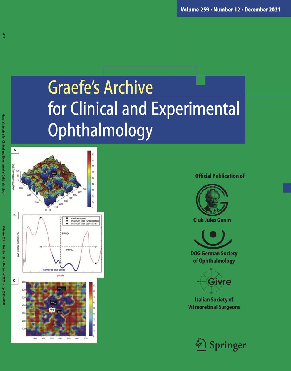 diepbiomed's tweet photo. Graefes Dec https://t.co/zwYnfSFbED Intraretinal expansion fluid-displacement retinal parenchyma/capillaries @ClinMedJournals @Ophthalmologen @meyer_professor @oliverzeitz @AndrzejGrzybow @EdmundTsuiMD @SakamotoTaiji @KopicAndrijana @JiaHorungMD @KusuharaSentaro @SpringerSurgery https://t.co/OnzXQfO6N7