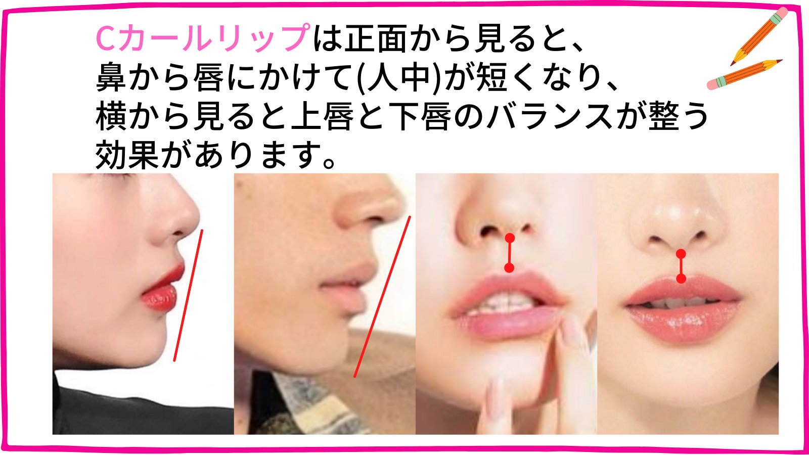 Twitter 上的 フィラークリニック 公式 スマイルリップと人中短縮ヒアルで いつだってcカールリップに Cカールリップは正面から見ると 鼻から唇にかけて 人中 が短くなり 横から見ると上唇と下唇のバランスが整う効果があります どの角度からでも可愛い唇が