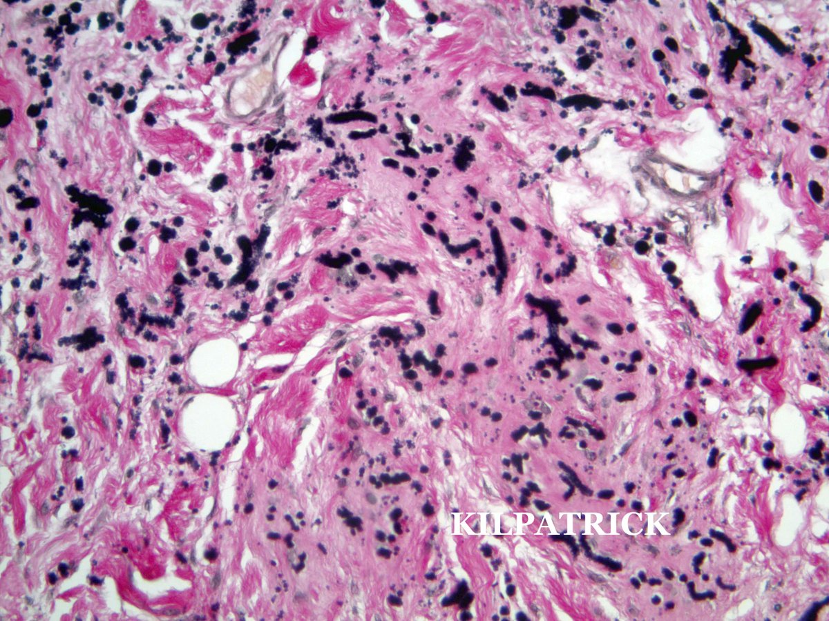ScottBikeethan's tweet photo. Elastofibroma, a rare, benign but poorly circumscribed soft tissue tumor usually located at the lower pole of the scapula. Patients may have a long history of swelling, discomfort or pain. Dark stained beaded and enlarged elastic fibers are seen with elastin stain. #CCFpathres https://t.co/NzQFhRu0Ww