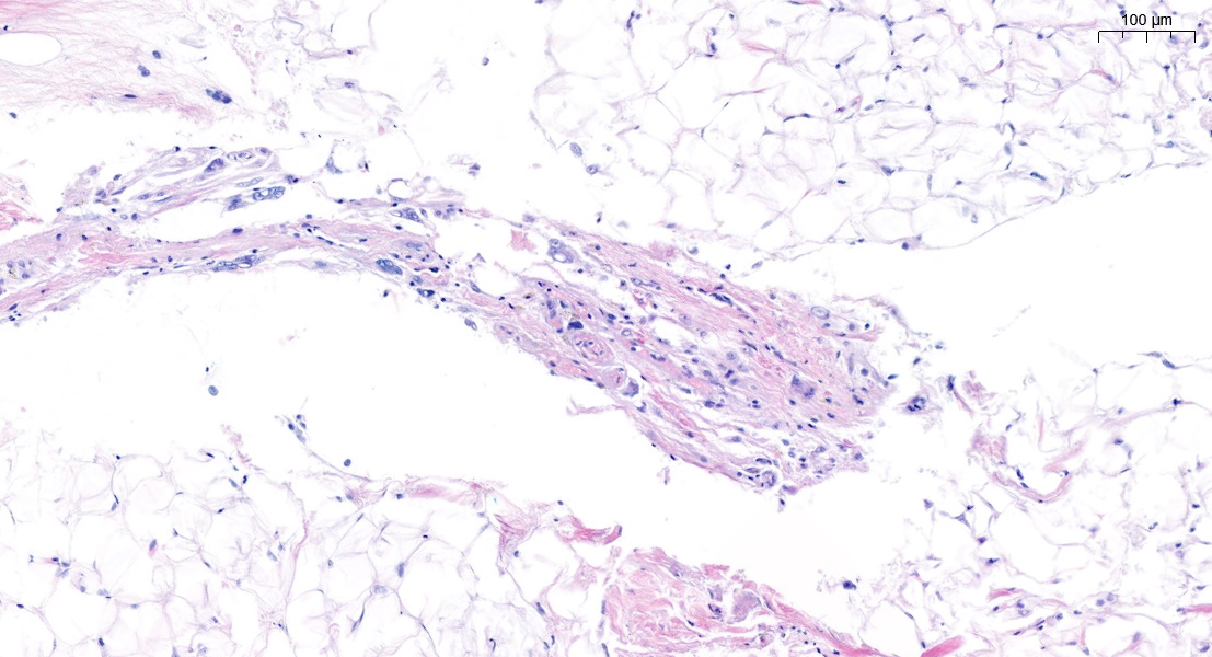 FliquiPath's tweet photo. Man, 61 years old with retroperitoneal mass (18 cm). IHQ for MDM2 was negative. FISH for MDM2 not amplified.  Could it be atypical spindle cell/pleomorphic lipomatous tumor? What do you thnik?🤔
#BSTPath #adipocityctumours #pathresidents #twitterpath https://t.co/826S50wzJb