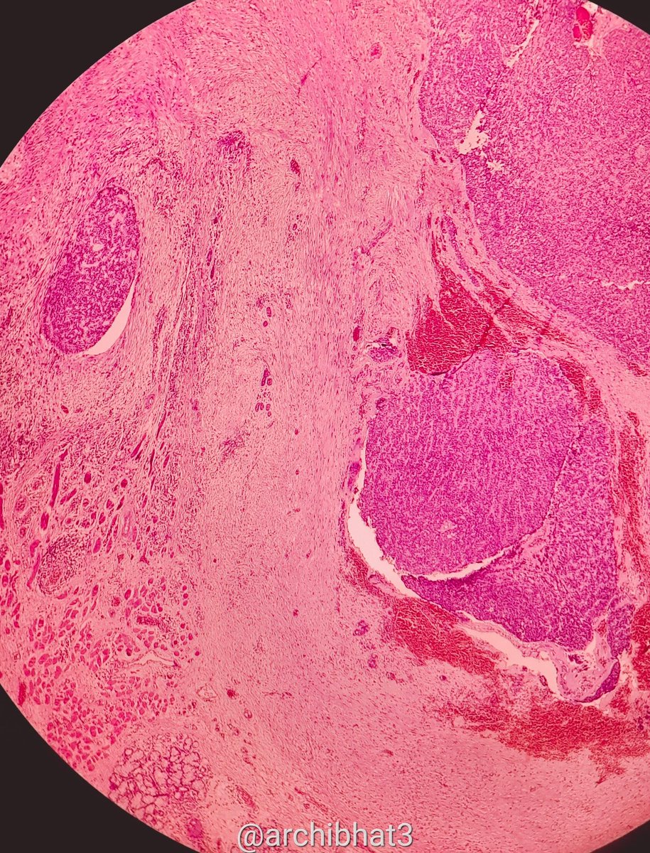 archibhat3's tweet photo. Prolifeartive growth on the lip. Your opinions please #PathTwitter #pathboards #pathspotters @vi_monappa @DrVasudevPrabhu @VijayPatho @JMGardnerMD @pembeoltulu @DrGeeONE @padmapathology1 @LoboAnandi @premcharles @ADamronMD @atman_ci @DrFouzia8 @adi_agnihotri @ChristinaGoveas https://t.co/NMxL8udrTA