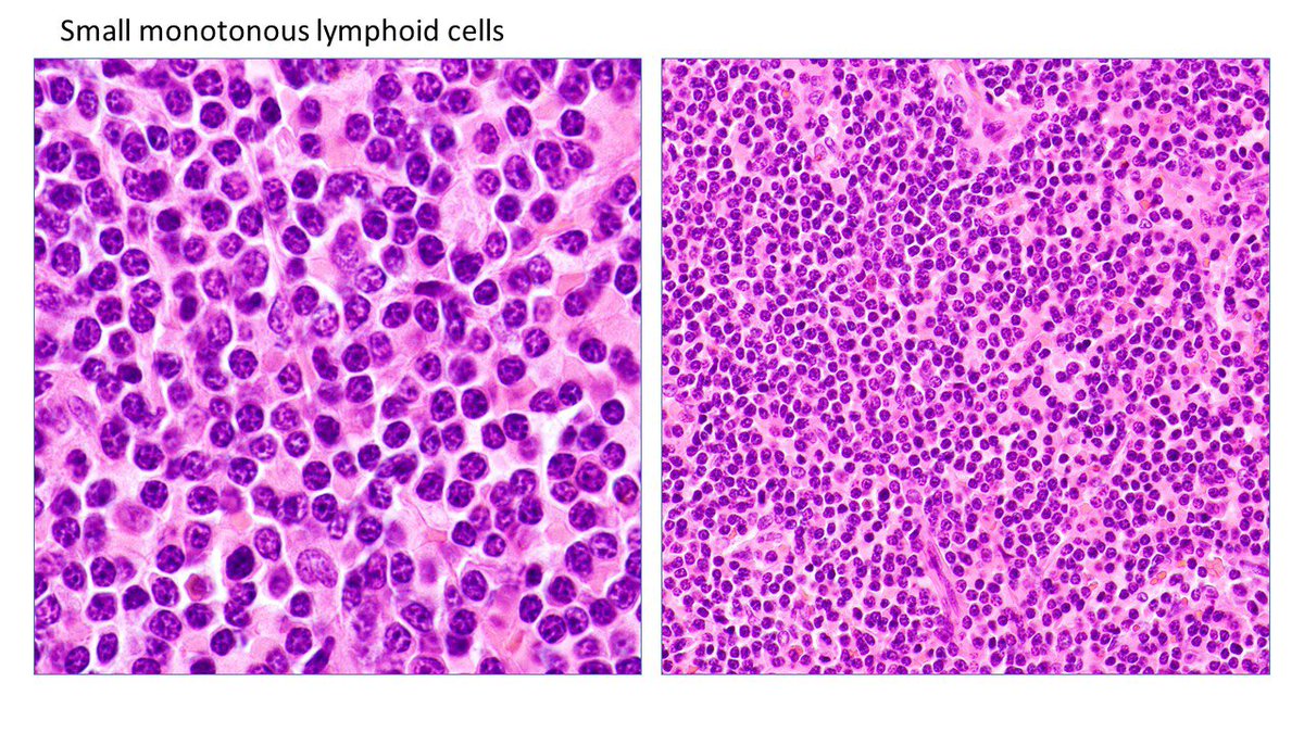 judith_ferry's tweet photo. 5 years later splenectomy was performed. 1100gm. Note diffuse pattern with no white pulp accentuation. Morphology with results of special studies makes my diagnosis splenic diffuse red pulp small B-cell lymphoma. https://t.co/MCTM9cmbLg