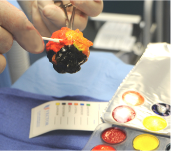 VectorSurgical's tweet image. Tissue orientation research by @UMNSurgOnc found that “intraoperatively inking is more effective at guiding re-excision of positive margins.” #positivemargin @AltmanAriella @JHuiMD doi.org/10.1111/tbj.13…