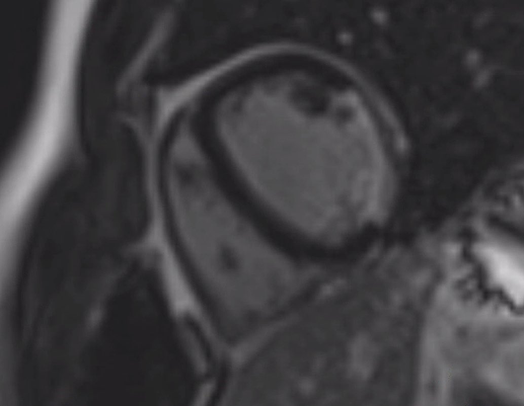 HBP CRT case. Intrahis conduction block with recruitment of LB in Strauss LBBB and normalization of LV electrical activation. Selective HPB revealing evidence of PL infarction with Q inferolateral and predominant R waves precordial leads. Very exemplary #Epeeps #dontdisthehis