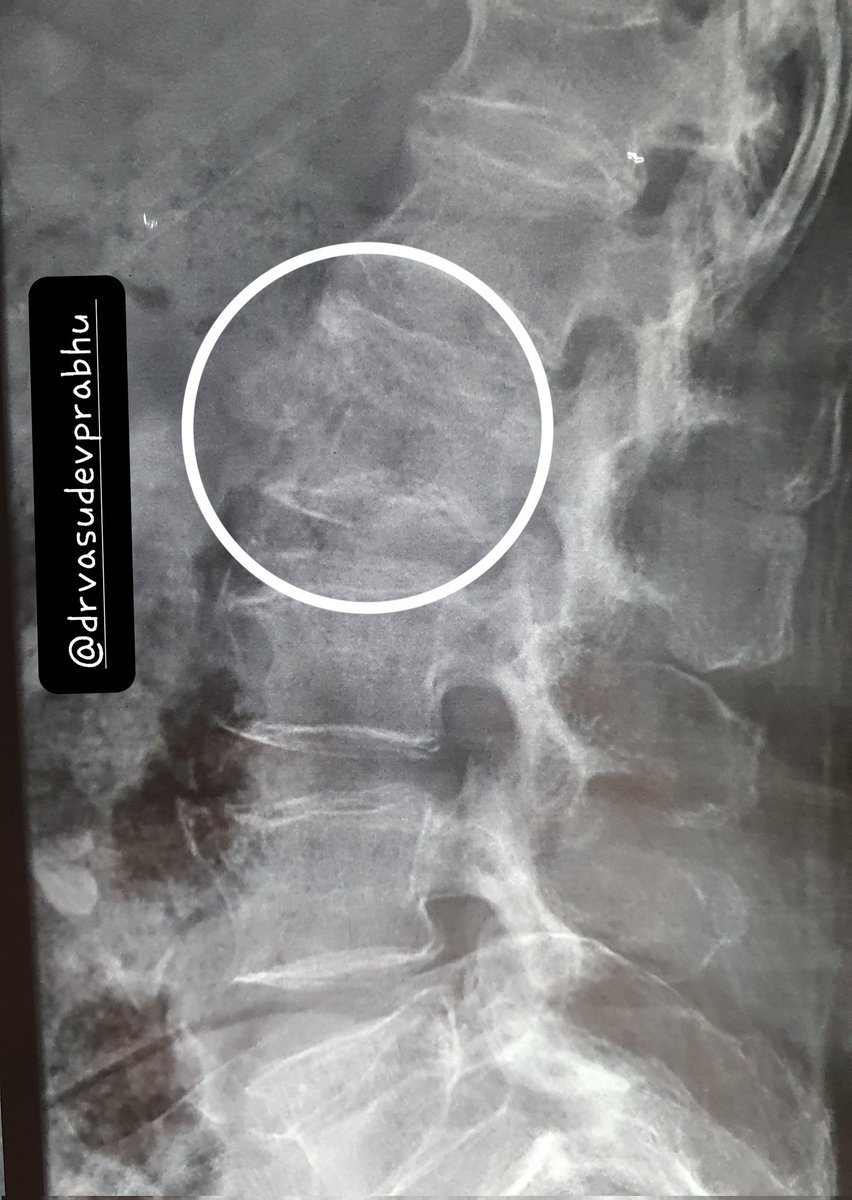 DrVasudevPrabhu's tweet photo. Elderly female, compression pathological fracture of L1,
MRI -marrow edema.
Transpedicular biopsy.
🔬Morphology Granulomatous process showing calcification.
Patient under Eval for kochs.
#BSTPath #bonepathology @anjuthevirgo @archibhat3 @tumashankar @RizviUroos @DrApoorvaN1 https://t.co/blMrQvueUV