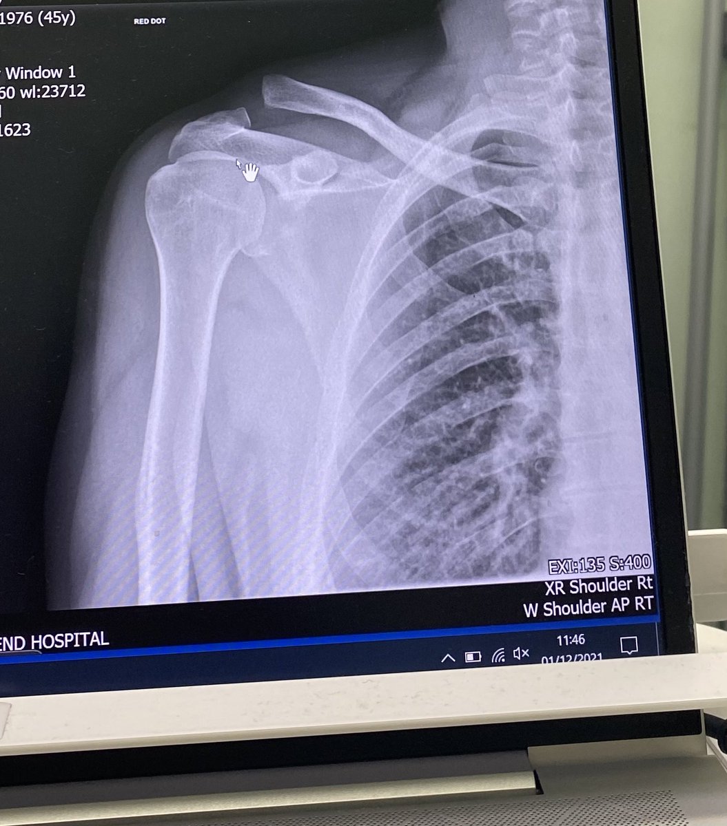 halpin76's tweet image. So the worst 6 weeks ever of my 45 years on this planet have come down to me having a dislocated collar bone, very painful and no #Golf for at least another 6 weeks. Thought last year was shit, but 2021 has out done it and then some. #FuckMyLuck