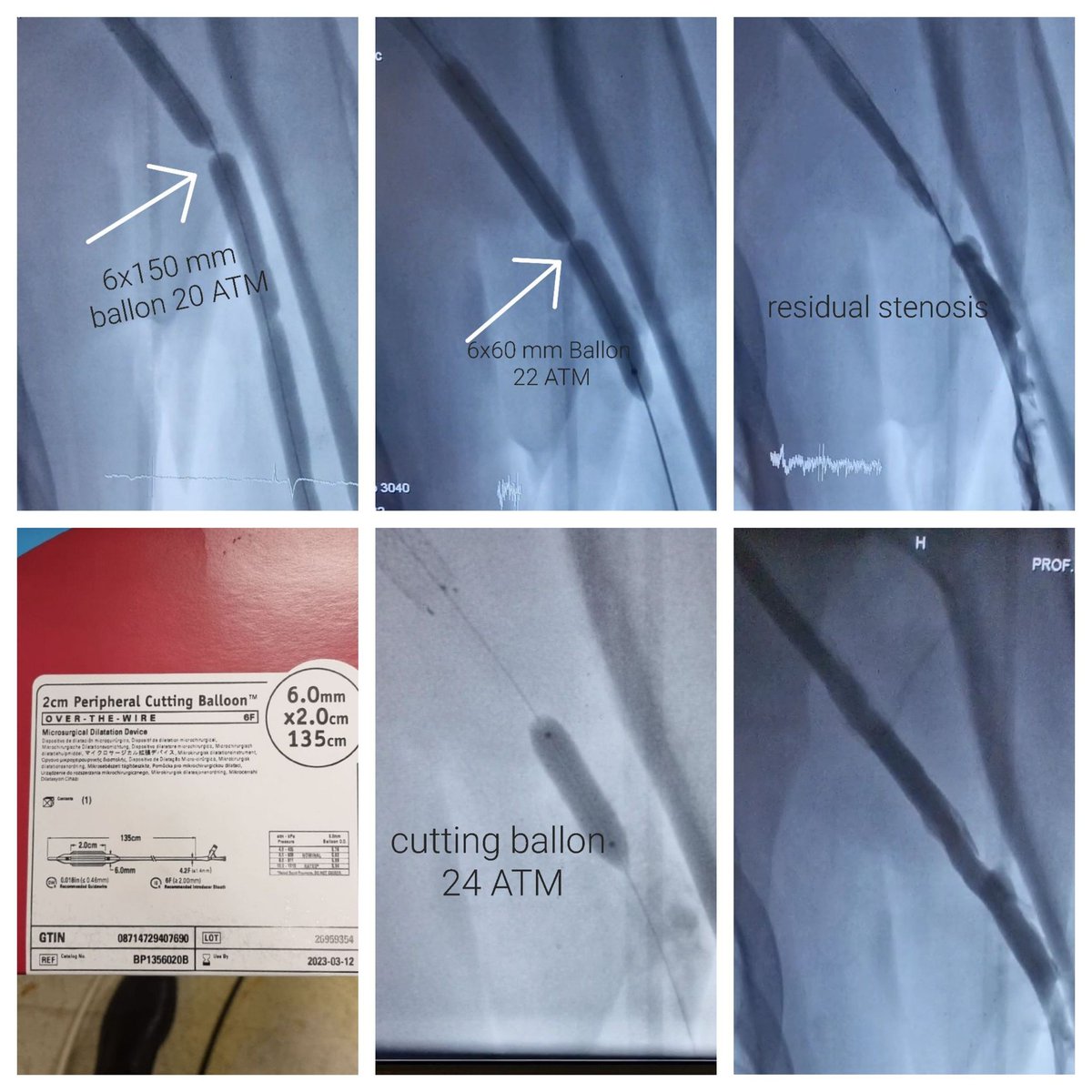 Brachiocephalis dialysis fistula, cephalic severe, hard lesion, resistant to dilation. The shorter balloon did not open despite the high pressure.  Then, cutting balloon solved the problem easily.What would be your other suggestion? #fistulafirst