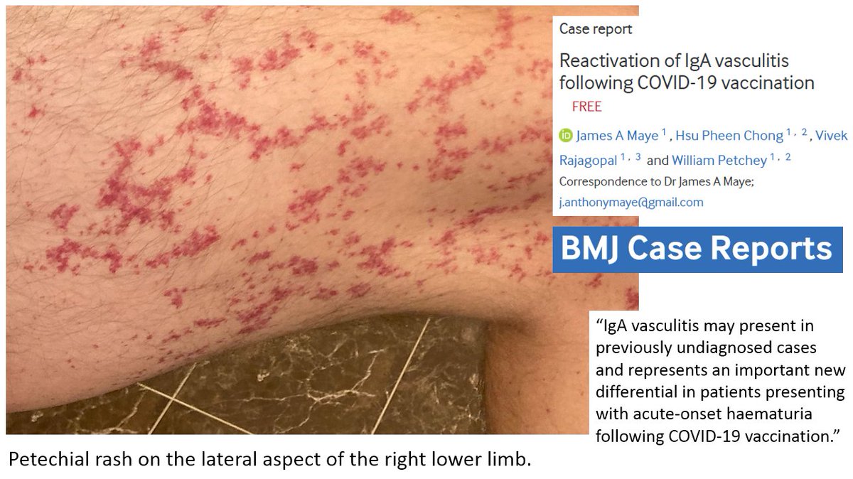 Se cura la vasculitis Se cura la vasculitis