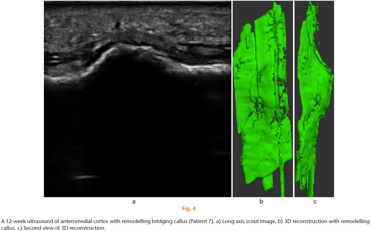 3D reconstruction of sonographic callus may ⬆️ usability of #ultrasound to monitor #fracture #healing 🦴

3D bridging callus 78% sensitive &amp; 100% specific in predicting union 6wks post tibial IMN, w/ excellent reviewer agreement (ICC 0.87)

online.boneandjoint.org.uk/doi/full/10.13…

#orthotwitter
